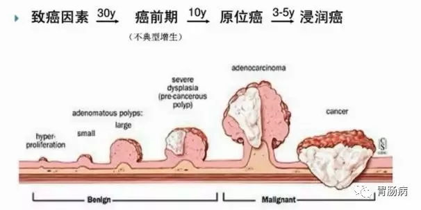 體檢查出腸息肉一定要切除！ 95%腸癌由它演變而來